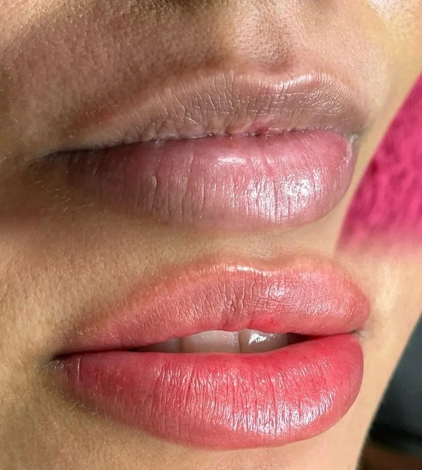 Antes e depois real de revitalização labial